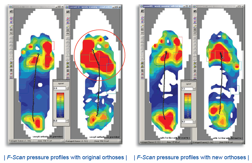 Plantar Pressure Measurement Foot Pressure Measurement in a Clinical